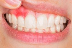 Thường xuyên chảy máu chân răng: Cảnh báo 4 căn bệnh nguy hiểm đừng chủ quan