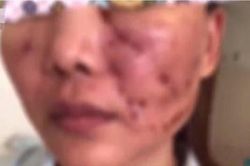 Tiêm má baby, cô gái hóa...'quỷ dữ'
