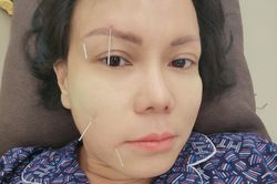Việt Hương bị méo mặt, phải châm cứu