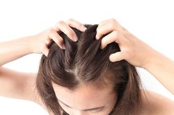 Gàu nhiều khi thời tiết nắng nóng giải quyết thế nào?