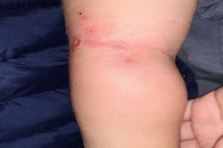 Bé 25 tháng nhiễm khuẩn huyết chỉ qua vết muỗi đốt