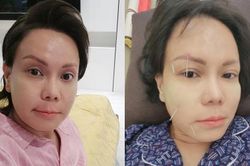 Việt Hương bị méo mặt, toàn thân phủ kín bởi 50 cây kim châm cứu