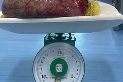 Quảng Nam: Phẫu thuật thành công khối u nang buồng trứng nặng 8,1kg