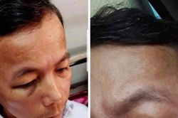 Quảng Bình: Hiệu trưởng đánh hiệu phó nhập viện