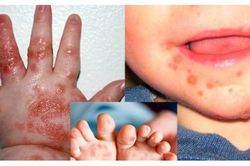 Đã có trẻ mắc tay chân miệng nặng, biến chứng nguy hiểm: 6 khuyến cáo phòng chống bệnh cần biết