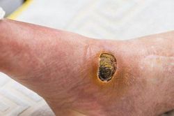 Bác sĩ cảnh báo biến chứng bàn chân ở bệnh nhân đái tháo đường