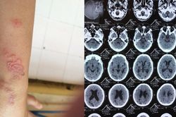 Tưởng bị đột quỵ, người đàn ông chữa mất 2 năm mới phát hiện có ấu trùng sán dây trong não