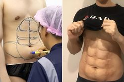 Phẫu thuật 'khắc bụng' 6 múi vì lười tập gym