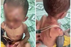 Bé trai 1 tuổi người chi chít vết thương, nghi bị cha mẹ bạo hành