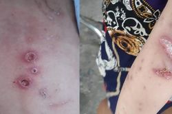 Vụ bé trai nghi bị cha mẹ đánh đập dã man: Cháu bé bị gãy biến dạng cánh tay, bỏng độ 1-2