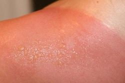 Da cháy nắng, cách điều trị và phòng ngừa