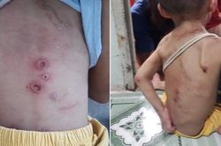 Công an điều tra vụ bé trai chi chít vết thương trên người, nghi bị bạo hành