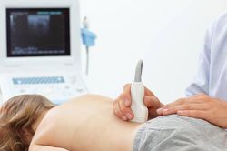 Tán sỏi qua da bằng đường hầm nhỏ
