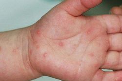 Tay chân miệng gia tăng tại Hà Nội: Phòng tránh thế nào?