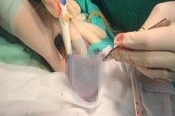 Cấp cứu nam thanh niên bị bò đá vỡ 'của quý'