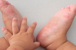Dấu hiệu trẻ mắc tay chân miệng cần nhập viện ngay