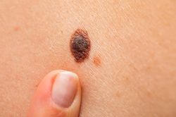 Đặc điểm của nốt ruồi cảnh báo bạn mắc ung thư da