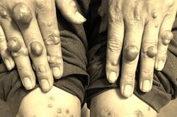 U cục mọc lổm nhổm 'đeo đẳng' người đàn ông suốt 8 năm, không ngờ 'thủ phạm' là mỡ máu