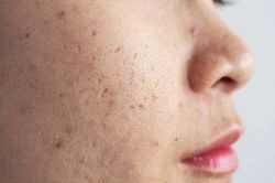 Bí quyết điều trị mụn ẩn dưới da an toàn trong mùa hè