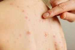 Những lý do khiến mụn lưng tiến triển dai dẳng và cách khắc phục