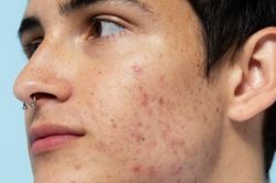 Bị mụn trứng cá, ăn gì để nhanh khỏi?