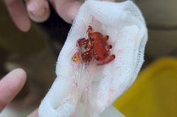 Bé 11 tháng tuổi bị hóc kẹp tóc
