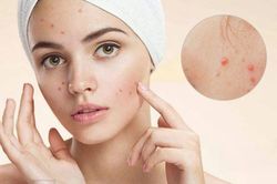 Điều trị mụn trứng cá hiệu quả nhất, không để lại di chứng trên da