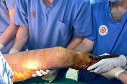 Ngã từ tầng 5, nam thanh niên 19 tuổi bị 3 thanh sắt đâm xuyên người