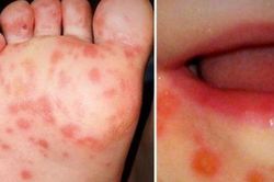 Tp.HCM: Đã có 4 ca tử vong do tay chân miệng