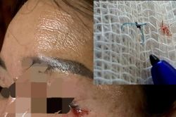 Thừa Thiên- Huế: Đi cắt mí mắt, sau 8 tháng còn sót lại chỉ khâu gần 2cm