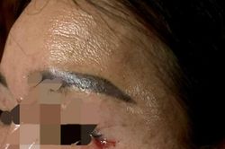 Phát hiện chỉ khâu mắt sau 8 tháng phẫu thuật thẫm mỹ
