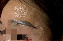 Huế: Làm rõ sự việc sau 8 tháng cắt mí mắt vẫn còn sót lại chỉ khâu