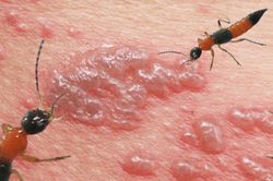 Loại côn trùng nọc độc hơn rắn hổ mang cắn khiến 2 người sưng vù mắt