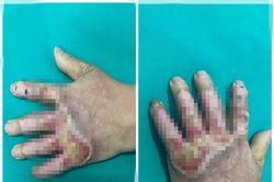 Nhiễm trùng nặng bàn tay sau khi tự đắp thuốc chữa bỏng