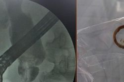 Nhiễm trùng nặng vì quên stent trong đường mật 2 năm
