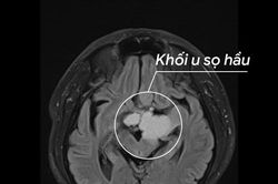 Cứu người đàn ông bị u sọ hầu hiếm gặp