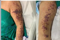 Sau khi ăn lòng lợn, người phụ nữ bị mắc liên cầu lợn