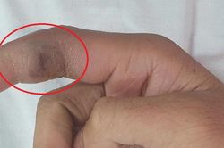 3 ngày sau khi tự nặn mụn, nam thanh niên nhập viện khẩn cấp