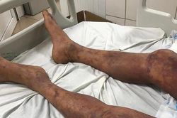 Thêm một bệnh nhân tử vong do nhiễm liên cầu lợn