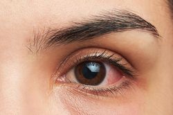 Bị đau mắt đỏ cần kiêng 6 điều dưới đây