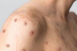 Sức khỏe những người tiếp xúc gần với ca mắc đậu mùa khỉ tại TP.HCM ra sao?