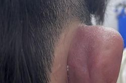 Nhiễm trùng, hoại tử vành tai do xỏ khuyên tai