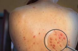 TP.HCM: Thêm ca đậu mùa khỉ thứ 5