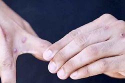 Phát hiện ca đậu mùa khỉ ở địa phương, Long An tăng cường giám sát