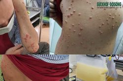 Rối loạn mỡ máu có nguy hiểm không?