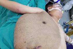 Người đàn ông được cắt bỏ khối u khổng lồ nặng tới 23kg