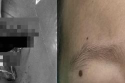 Chơi với chó, em bé 4 tuổi bị chó cắn đứt lệ quản dưới mắt, phải nhập viện gấp