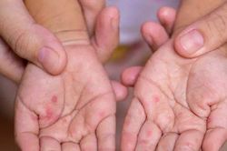 Tin tức Đời sống 6/12: Bệnh tay chân miệng có diễn biến bất thường