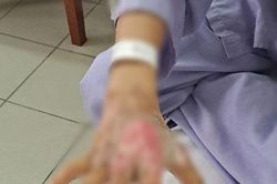 Đề phòng nguy cơ bỏng ở trẻ nhỏ