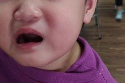 Bé 2 tuổi tuổi méo miệng, liệt dây thần kinh số 7 do trời rét đậm, rét hại